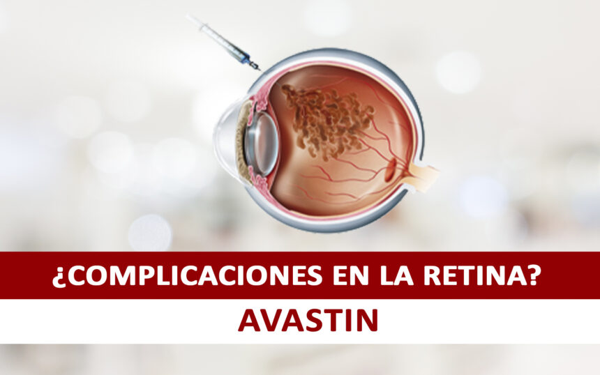 Combate las complicaciones en la Retina con el AVASTIN