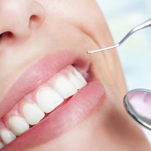 Profiláxis Dental