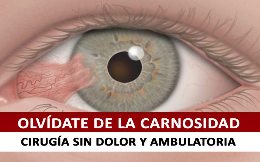 Pterigion – Síntomas, causas y cirugía Pterigion – Síntomas, causas y cirugía
