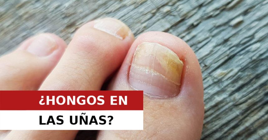 ONICOMICOSIS: El enemigo de tu pies en verano.