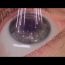 Defectos refractivos: causas, diagnóstico y opciones modernas de tratamiento
