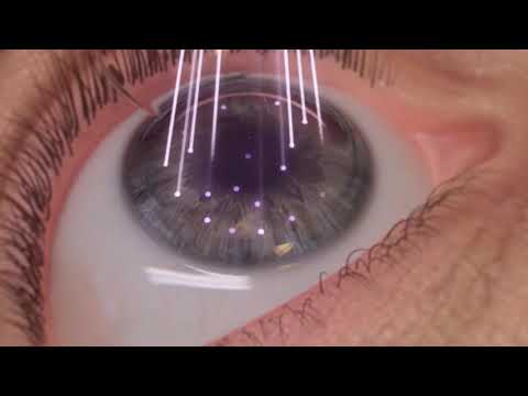 ¿Qué son los defectos refractivos? Tipos, síntomas, diagnóstico y tratamiento